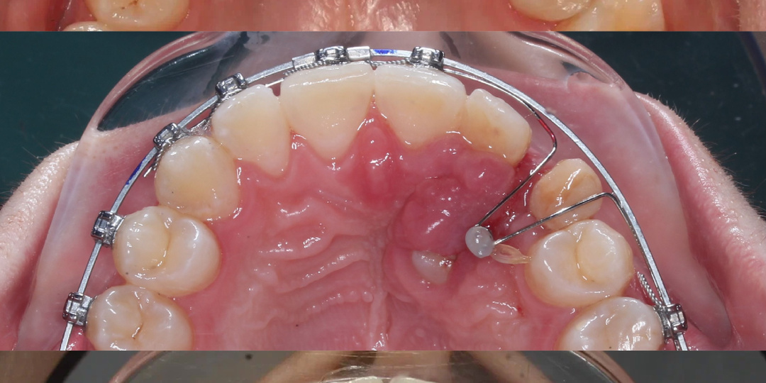 Как мы вернули клык на место?