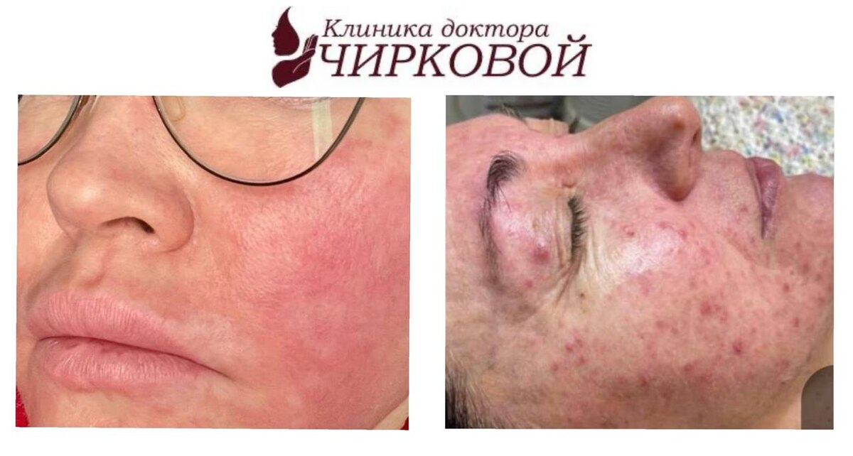 Розацеа у двух пациентов: отличие по форме и степени сосудисто-воспалительных изменений