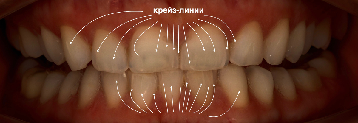Трещинки эмали, 