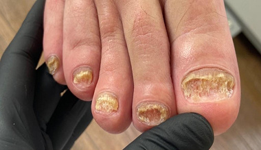 Ногти, пораженные грибком