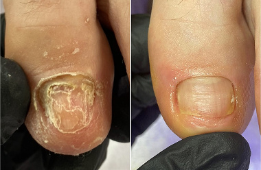 Обработка ногтя, пораженного грибком