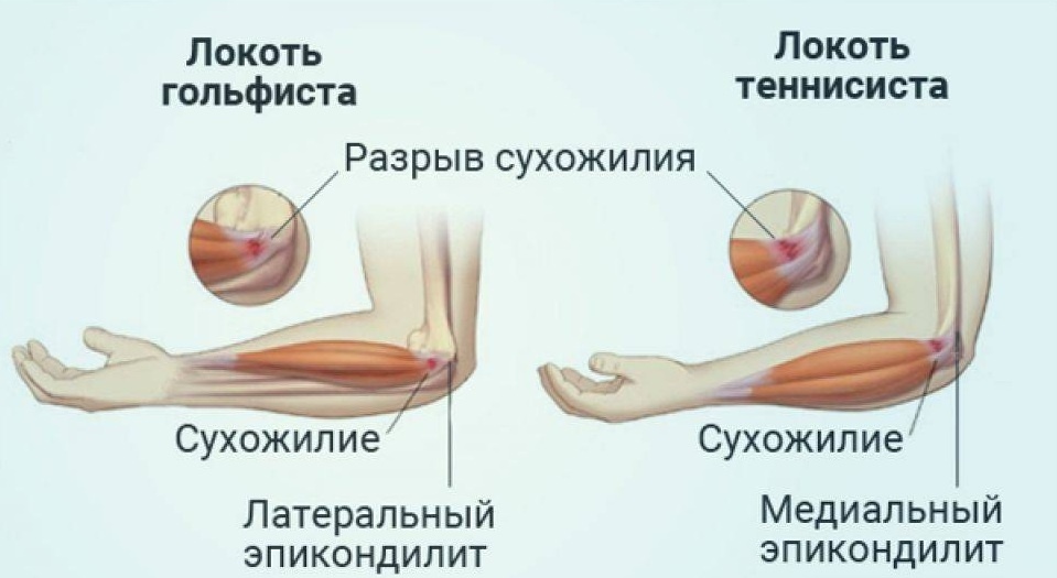 1. Латеральный эпикондилит. 2. Медиальный эпикондилит.