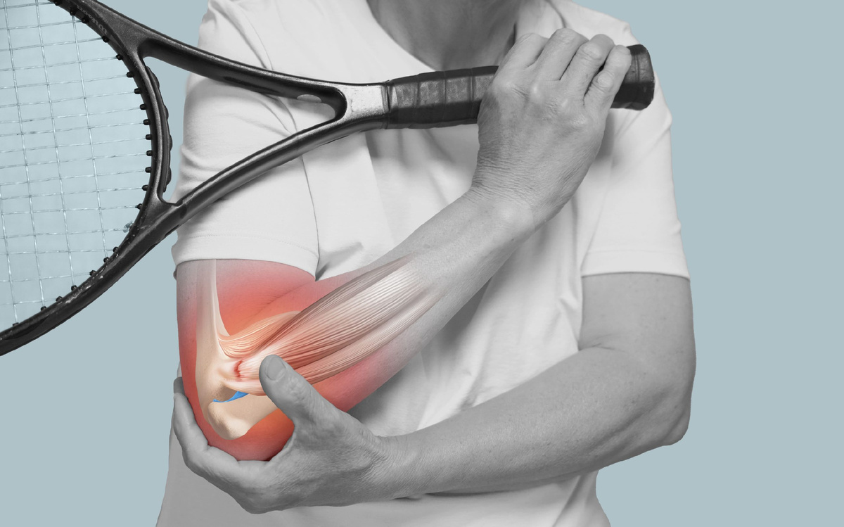 Симптом «теннисной ракетки» 