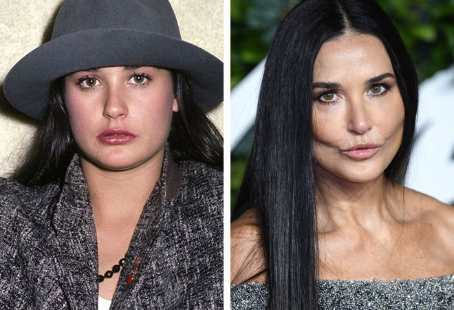 Деми Мур до и после удаления комков Биша