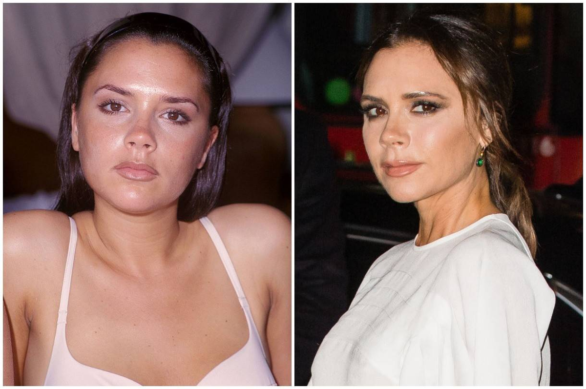 Виктория Бэкхэм до и после удаления комков Биша