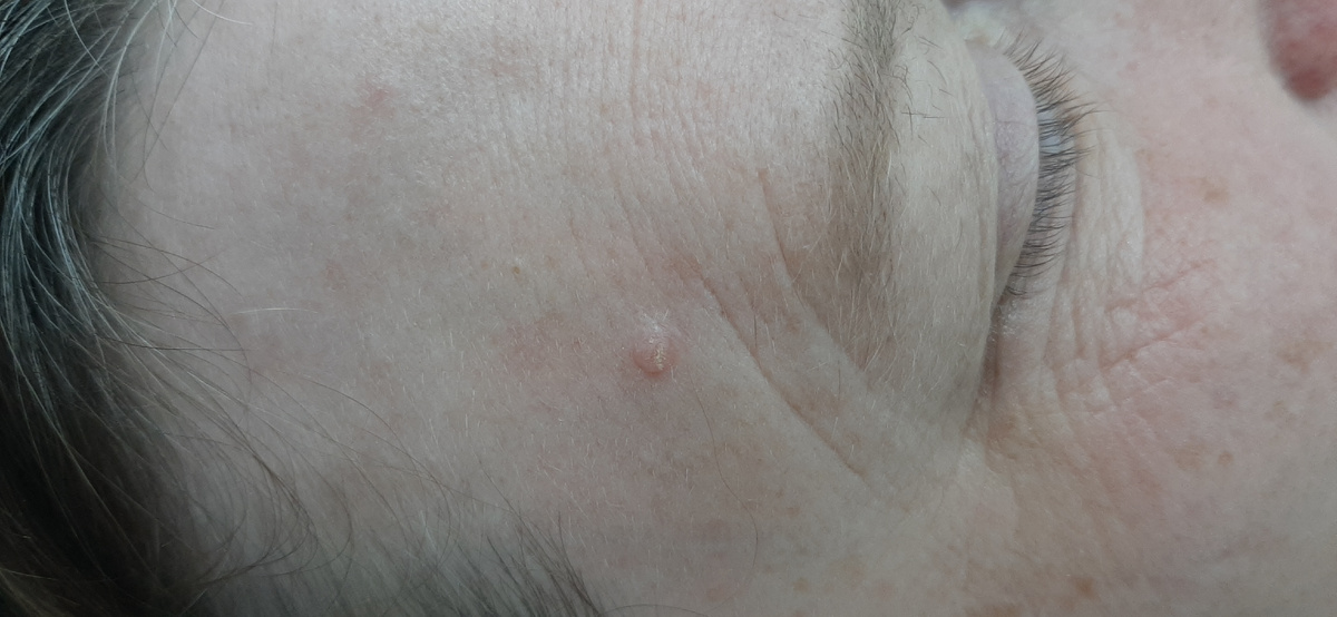 На представленном фото состояние перед операцией. Хорошо видно округлое новообразование кожи, расположенное в области лба справа.