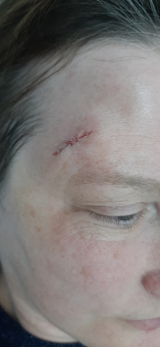 На фото после операции видна линия внутрикожного шва и два поперечных мини-узловых шва.