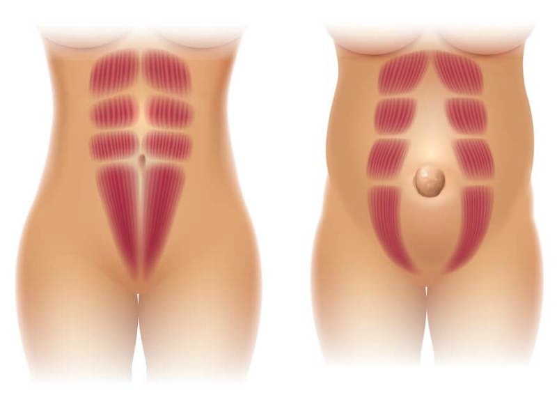 Диастаз прямых мышц живота. Источник: https://dr-isamutdinova.ru/blog/diastaz-pryamyh-myshts-zhivota-gryzha