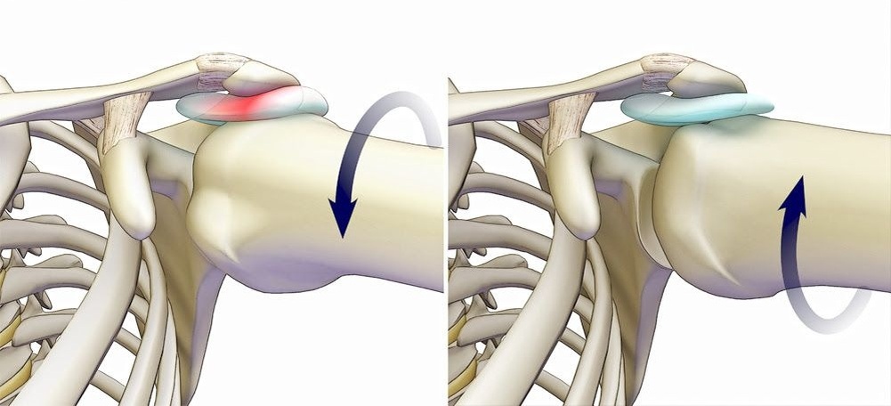 Сжатие синовиальной сумки (собственная жидкость в суставе).