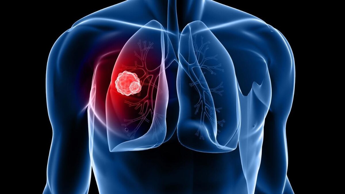 Почему Рак Лёгких Долго Не Даёт Симптомов