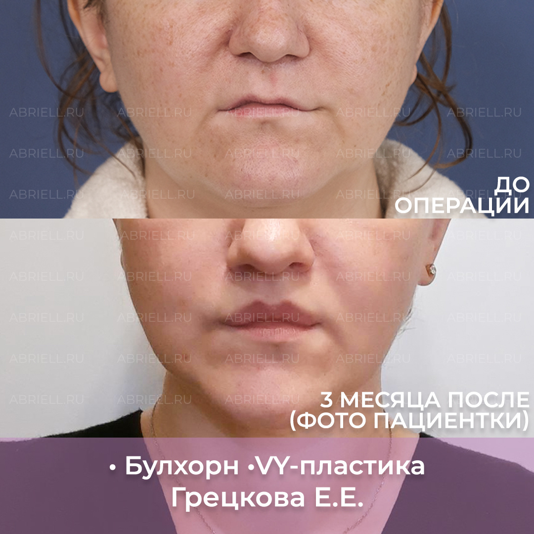 Пластика губ в Санкт-Петербурге / Увеличение методов VY-пластика и булхорн / Грецкова Евгения Евгеньевна 