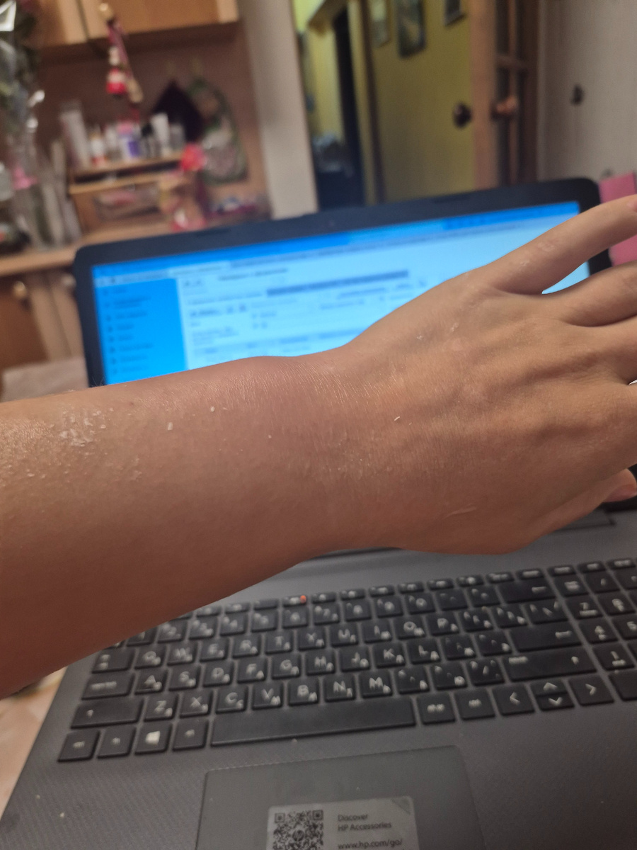 Вот так выглядело моё запястье в начале болезни