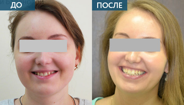 Адентия, лечение до и после