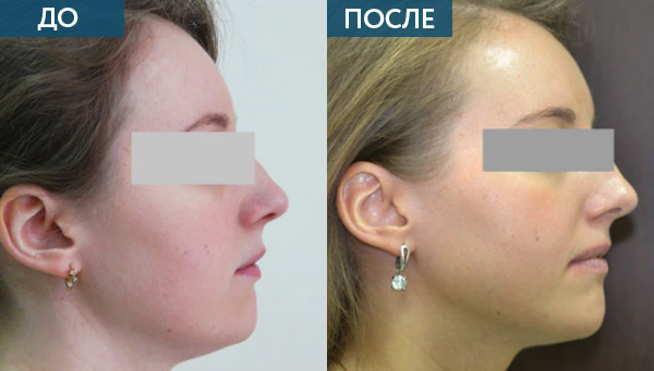 Лечение неправильного прикуса, фото. До и после