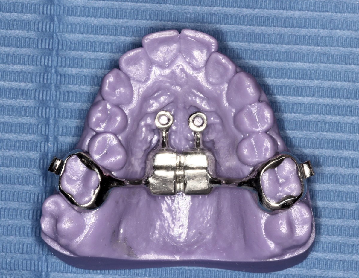 Marpe - быстрое нёбное расширение