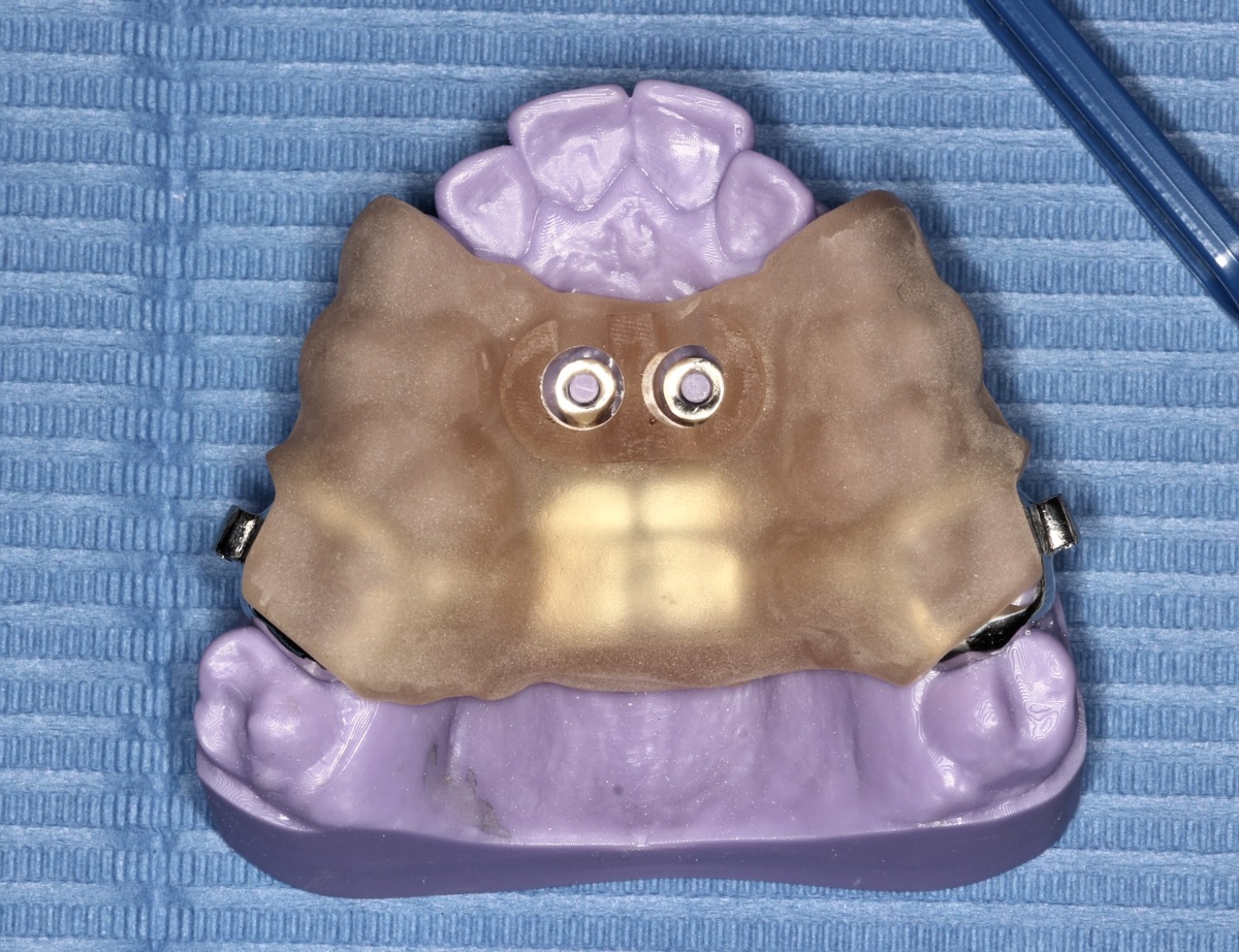 Хирургический шаблон для мини-имплантатов