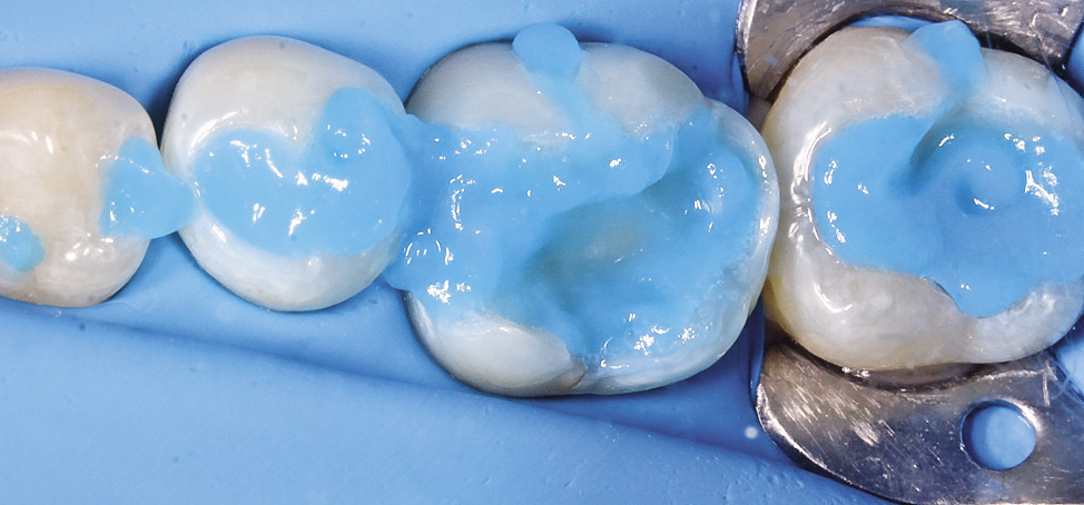 Кислотный гель на зубах