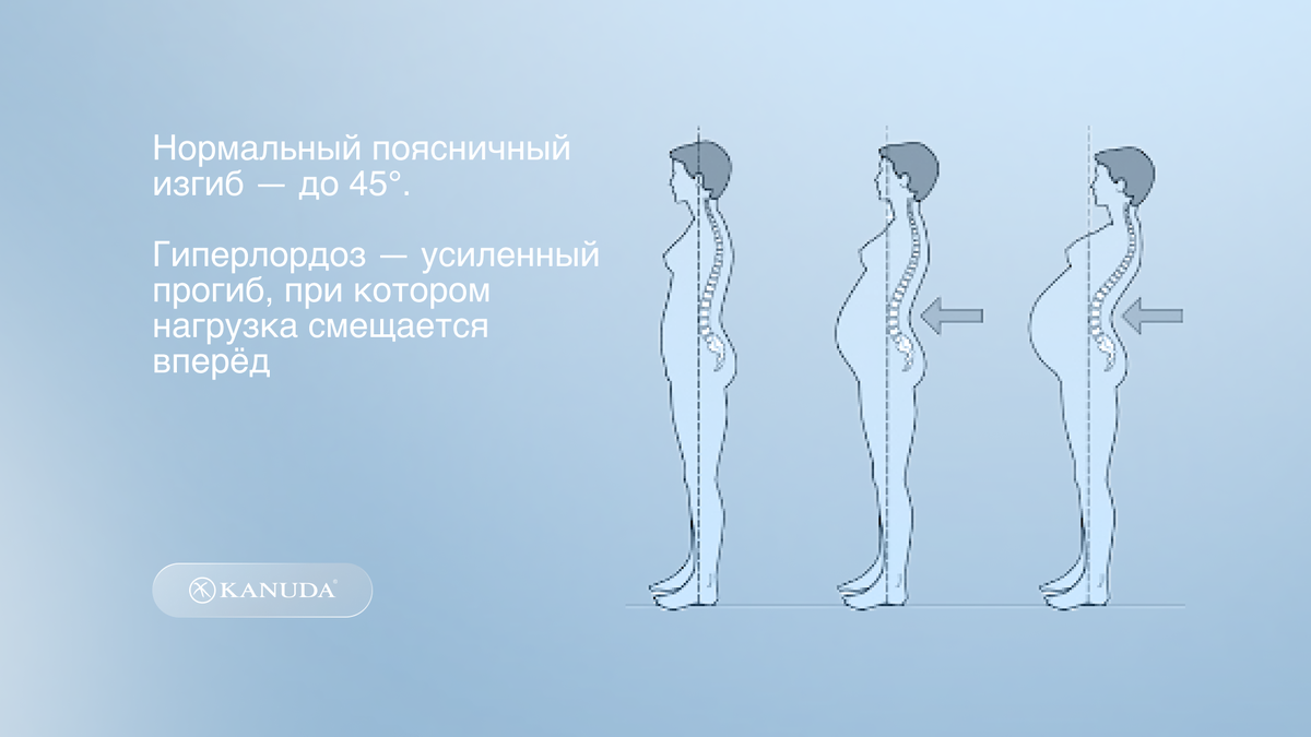 Градация развития гиперлордоза