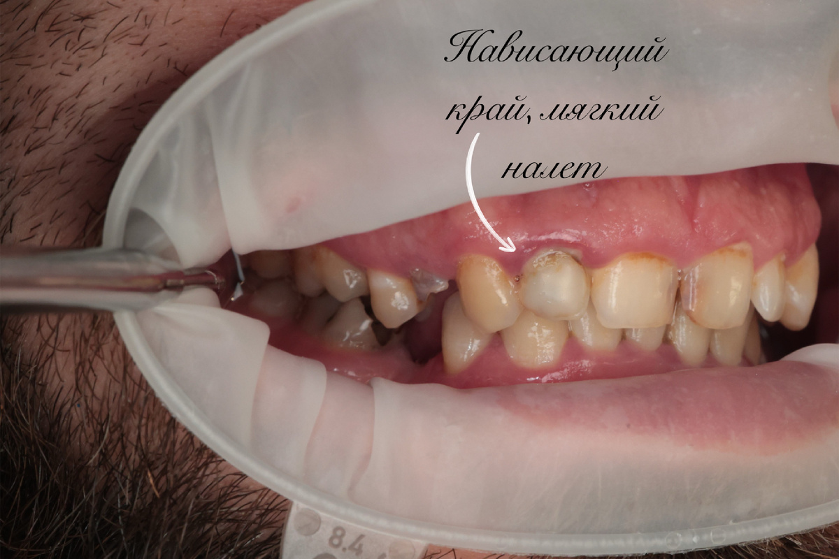 Нависающий край пломбы на зубе 1.2 был как ступенька, который скапливал на себе много налета