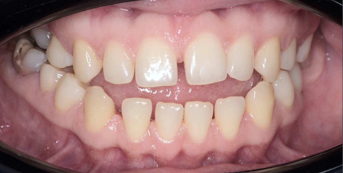 Скелетный открытый прикус мезиального типа