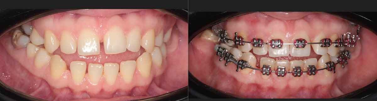 Скелетный открытый прикус - коррекция на брекет-системе. Внедрение верхних жевательных зубов