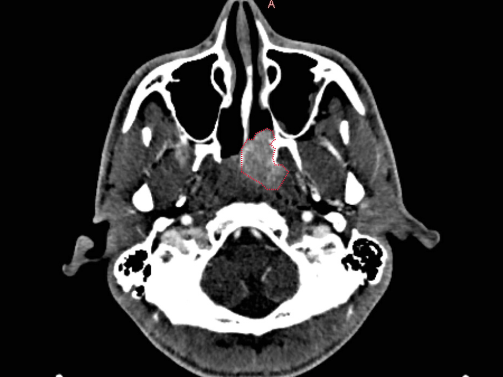 На МРТ видно образование - ювенильная ангиофиброма носоглотки