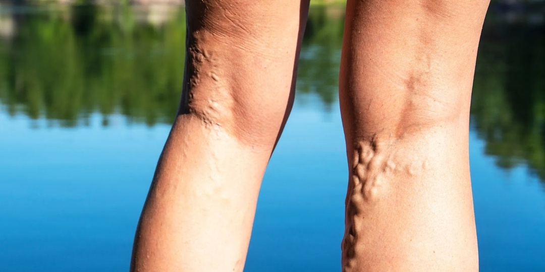 Варикозное расширение вен