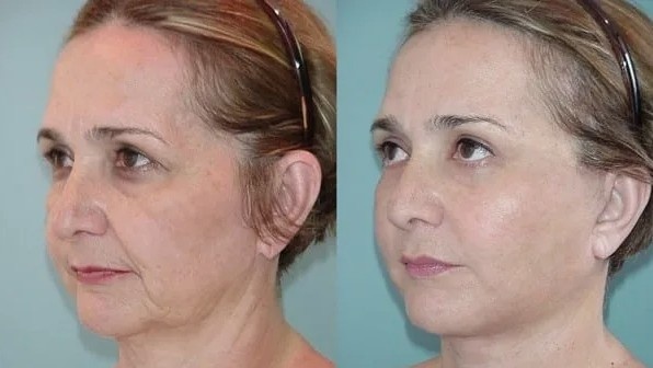 en.wikipedia.org / находится по запросу "ультразвуковой смас-лифтинг", но не является им