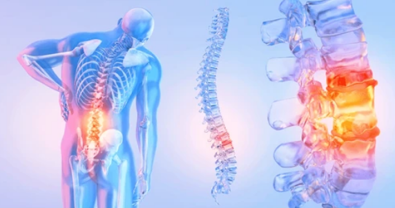 Экструзия диска. Что это такое? Отличие от грыжи и протрузии