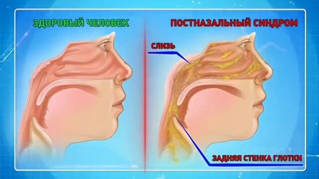 Слизь стекает по глотке и мешает жить. Есть эффективный способ решения