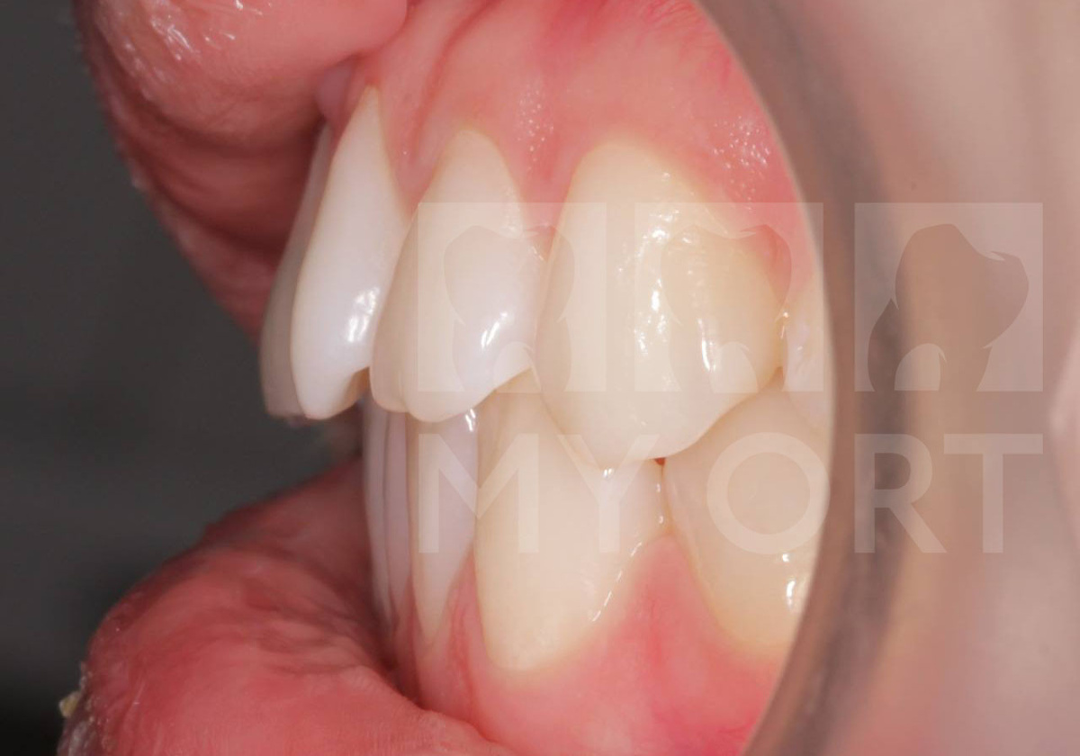 Ретрузия верхних резцов