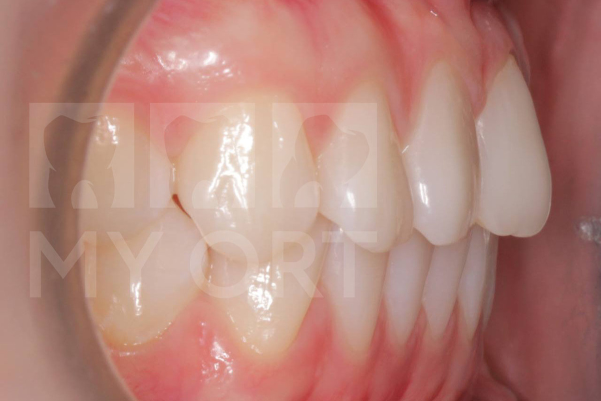 Ретрузия верхних резцов