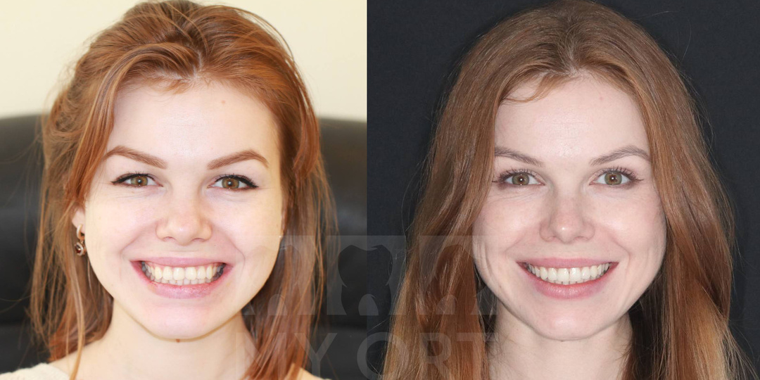 Пациентка не хотела носить брекеты — как мы вылечили прикус без них. Реальный случай