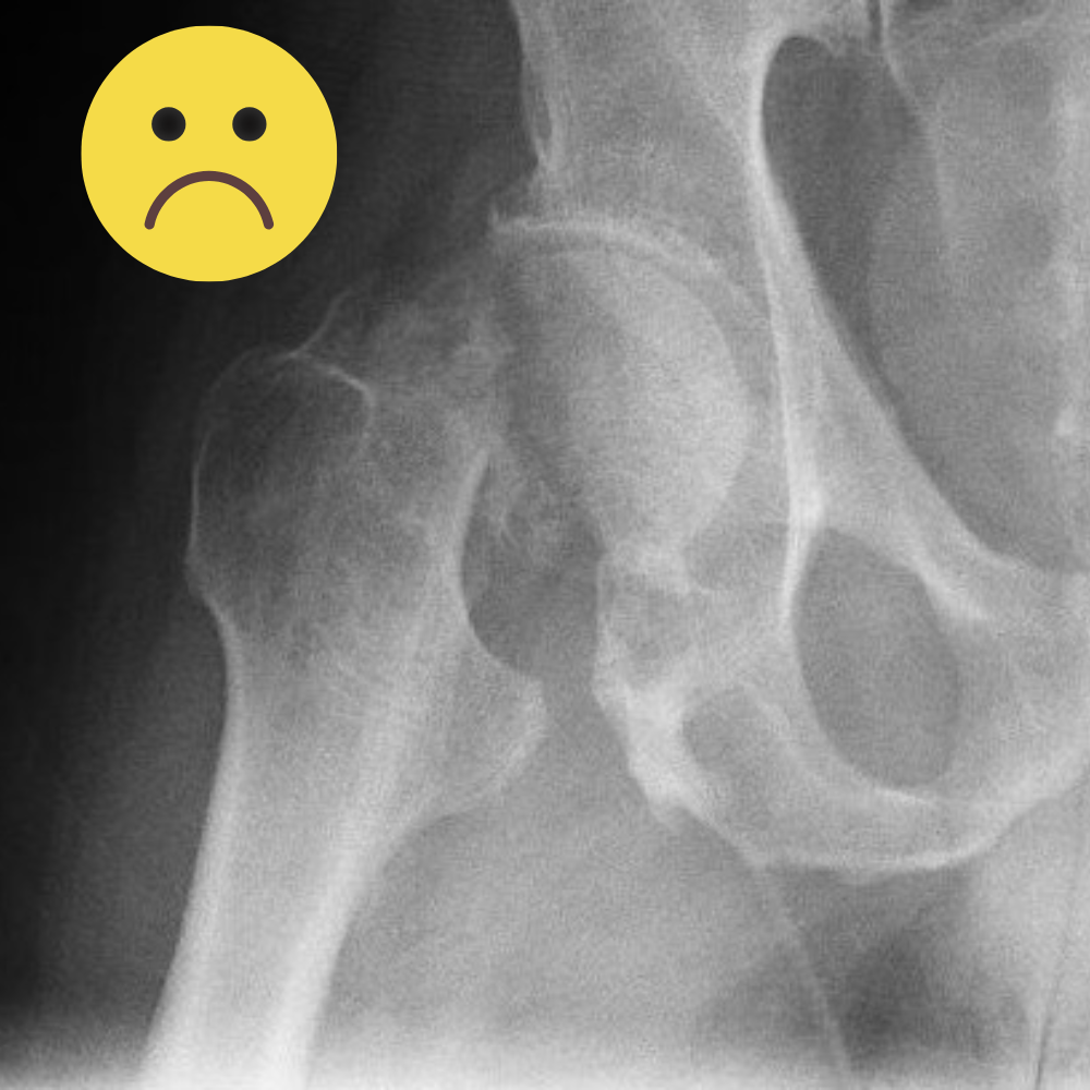 Рентгенограмма, иллюстрирующая перелом шейки бедра 