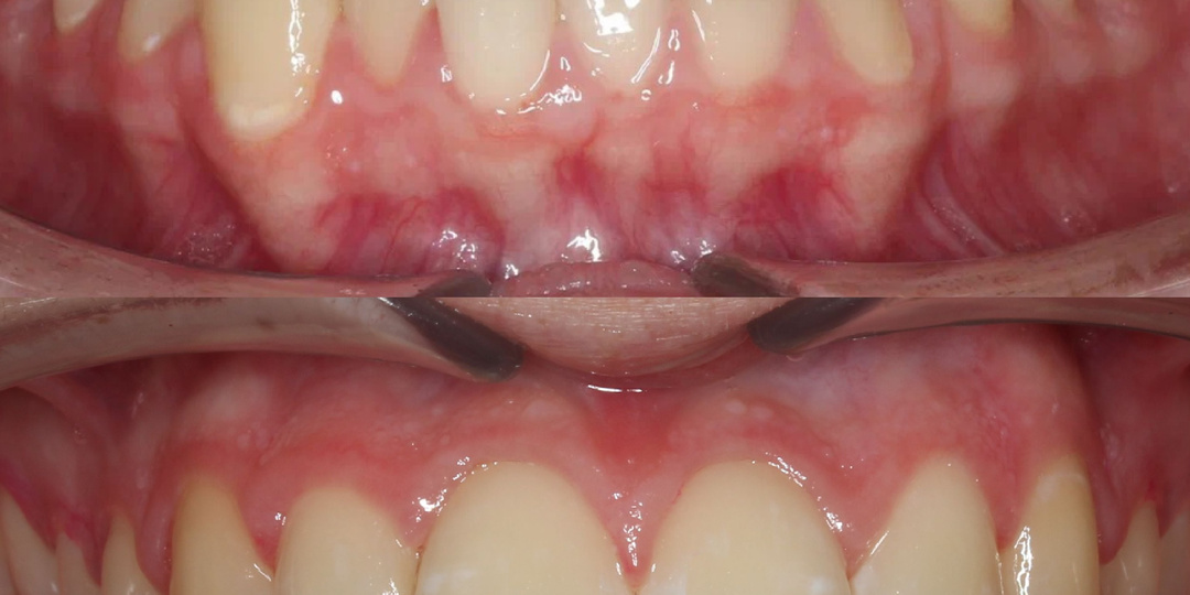 Что делать с дистопированными клыками?