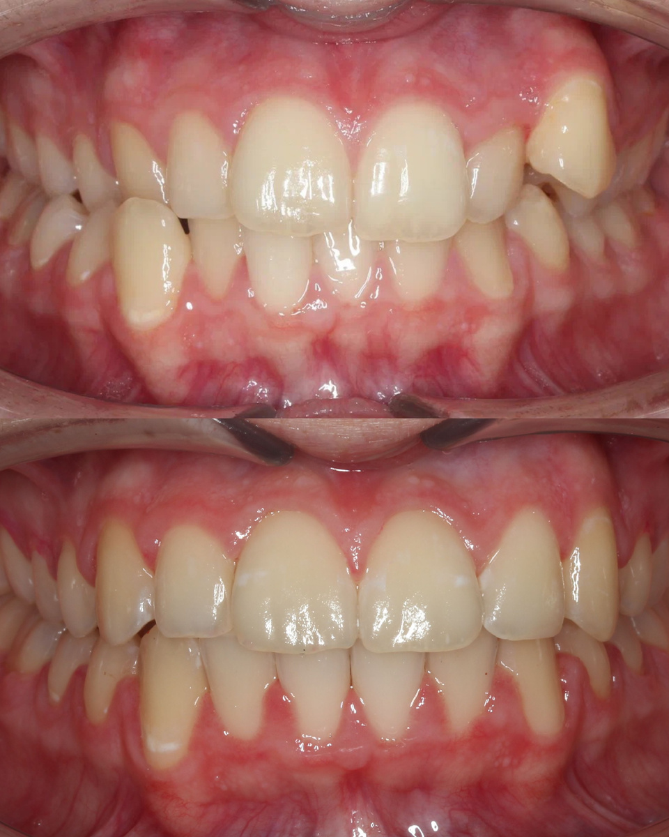 До/после ортодонтическое лечение