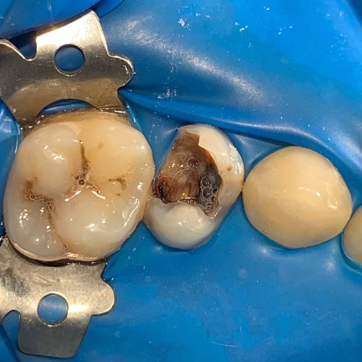 Диагноз хронического периодонтита зуба 25