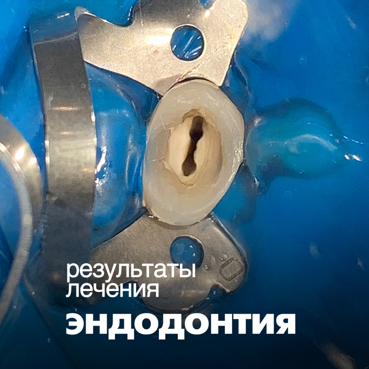 Результаты лечения периодонтита в клинике СТУДИЯ УЛЫБОК г. Сочи