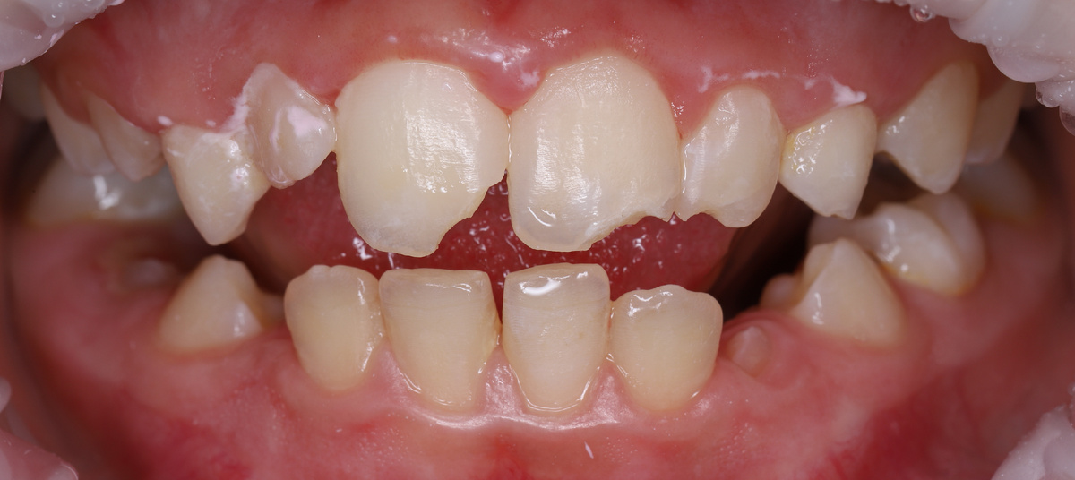 Эстетическая реставрация передних постоянных зубов у ребёнка. Фото до. 