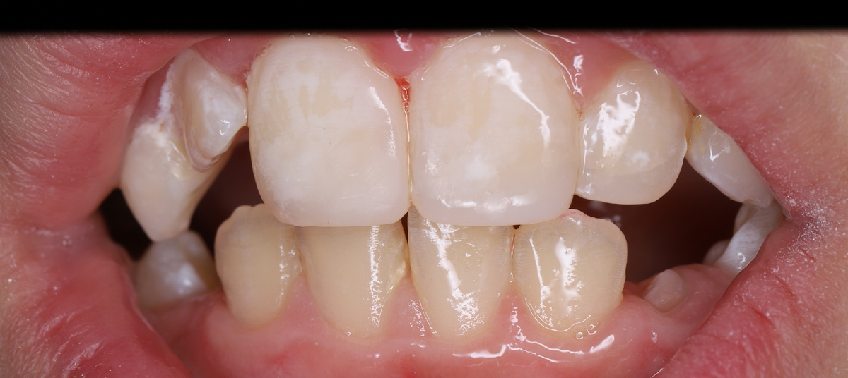 Эстетическая реставрация передних постоянных зубов у ребёнка. Фото после. 