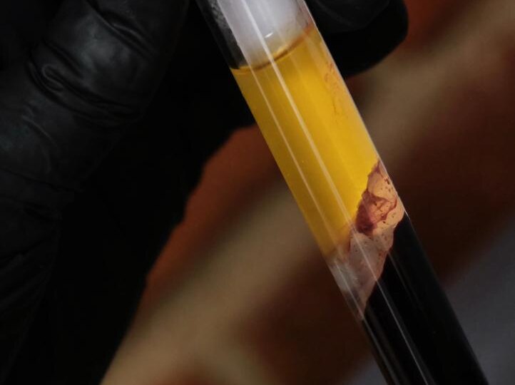 Анемия: как запасы железа влияют на вашу красоту