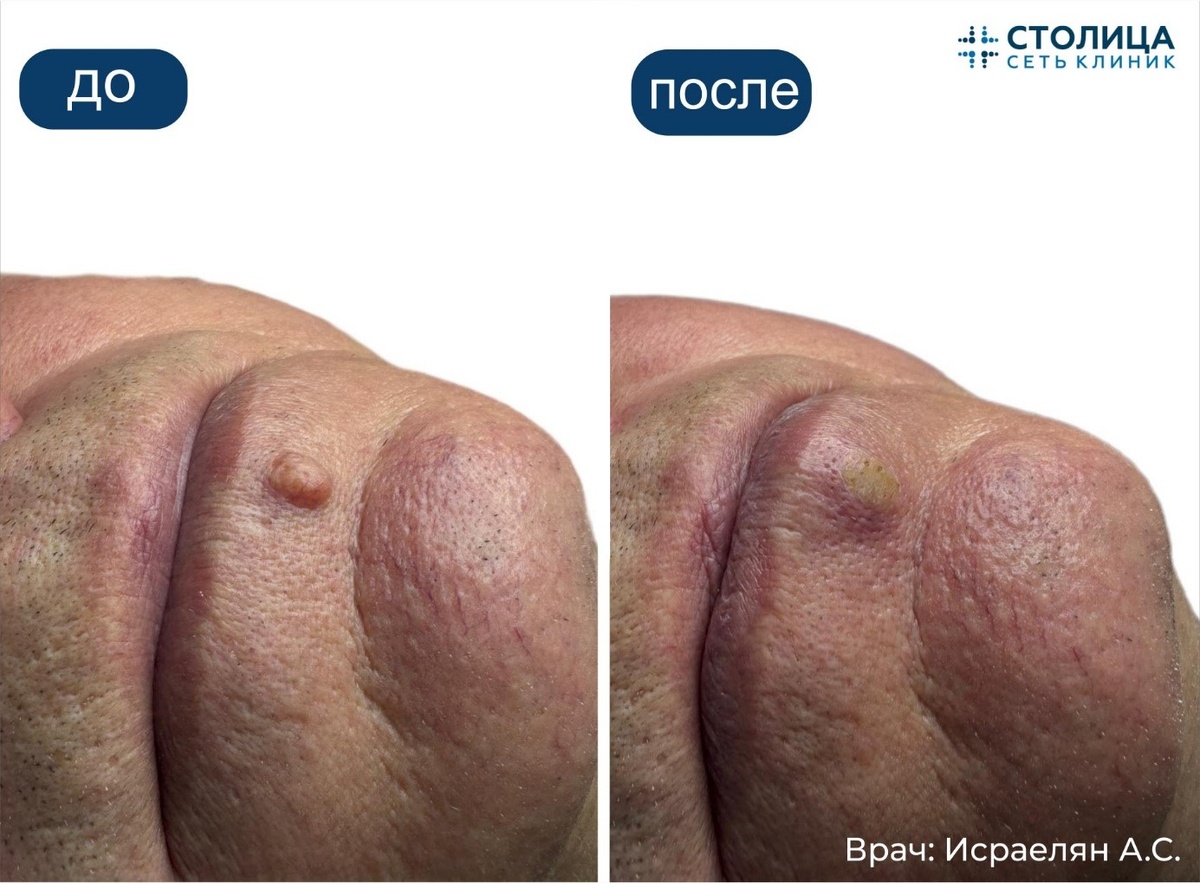 Удаление доброкачественного новообразования радиоволновым способом. Выполнил врач косметолог-дерматолог Сети клиник "Столица" Арсен Сергеевич Исраелян.