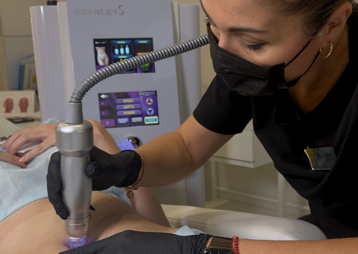 Главный врач клиники WayYou Елена Геннадьевна. Микроигольчатый RF на аппарате Scarlet для быстрого восстановления тонуса и эластичности кожи живота после беременности