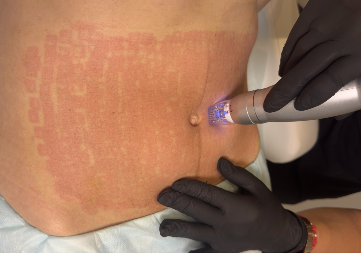 Микроигольчатый RF на аппарате Scarlet для быстрого восстановления тонуса и эластичности кожи живота после беременности