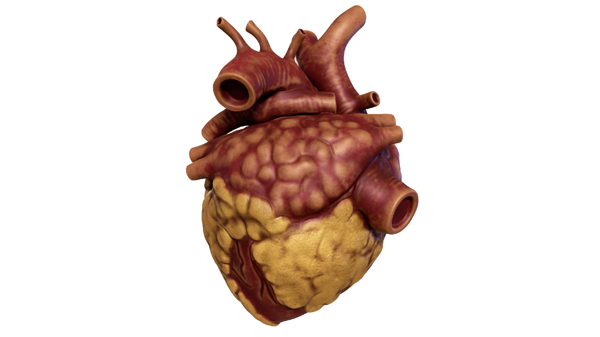 Сердце человека с накопленным жиром