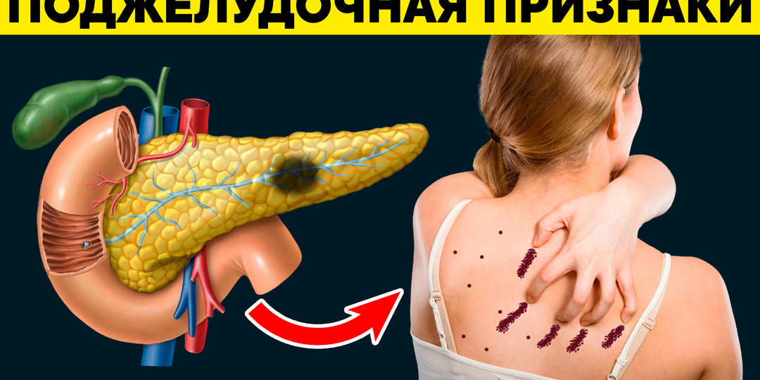 10 микросимптомов, которые часто пропускают при раке поджелудочной (чек-лист)