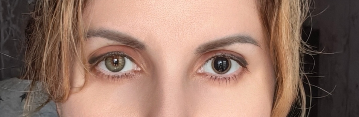 Так выглядел глаз после коагуляции