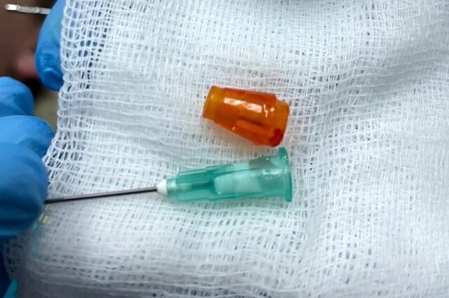    Ранее у двух маленьких пациентов в бронхах обнаружили деталь от конструктора и колпачок ручки. Фото: Ивано-Матрёнинская детская клиническая больница в Иркутске