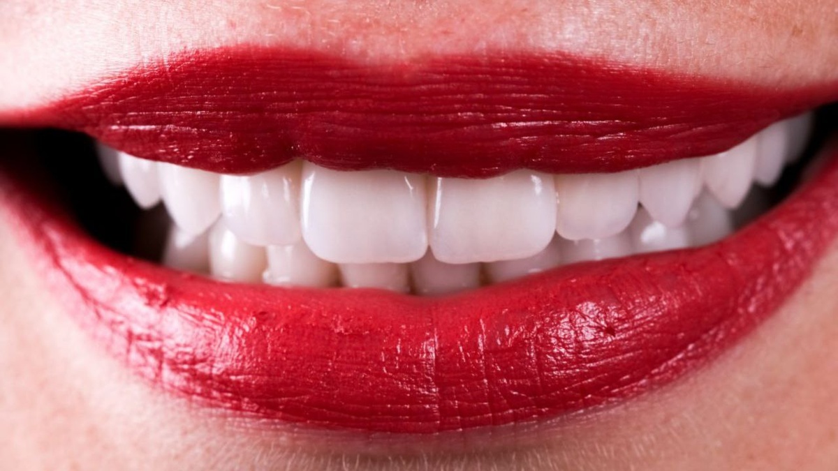 Одна красивая улыбка с помощью керамических виниров. 