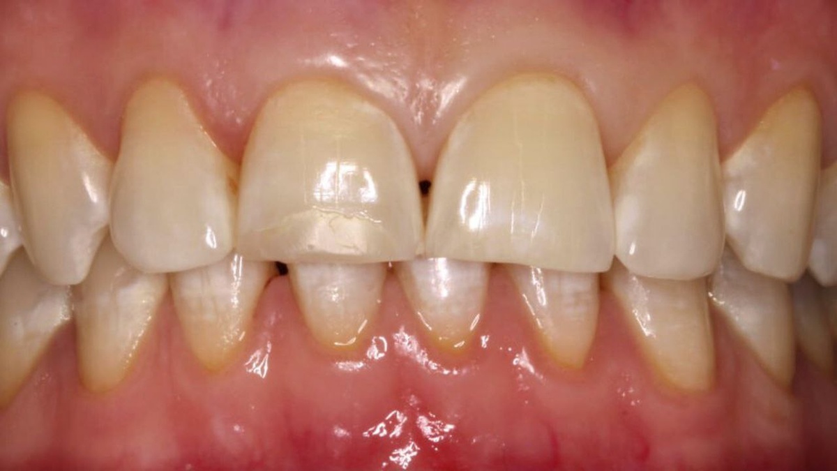 Фото ротовой полости нашей пациентки на момент обращения в клинику. 